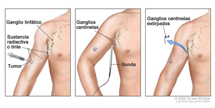 Ganglios inflamados del abdomen Ganglios inflamados del abdomen